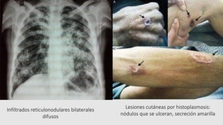 Infiltrados reticulonodulares bilaterales
difusos
Lesiones cutáneas por histoplasmosis:
nódulos que se ulceran, secreción amarilla
 
