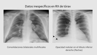 Datos inespecíficos en RX de tórax
Consolidaciones bilaterales multifocales Opacidad nodular en el lóbulo inferior
derecho (flechas)
 