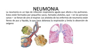 La neumonía es un tipo de infección respiratoria aguda que afecta a los pulmones.
Estos están formados por pequeños sacos, llamados alvéolos, que —en las personas
sanas— se llenan de aire al respirar. Los alvéolos de los enfermos de neumonía están
llenos de pus y líquido, lo que hace dolorosa la respiración y limita la absorción de
oxígeno
NEUMONIA
 