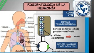 neumonia.pptx