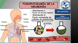 neumonia.pptx