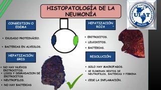 neumonia.pptx