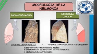 neumonia.pptx