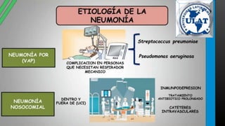 neumonia.pptx