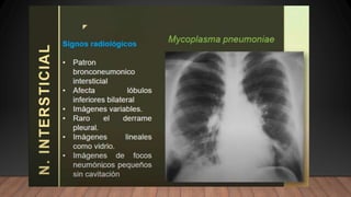 NEUMONIA.radiologia . Tipos ppt resumenn