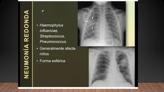 NEUMONIA.radiologia . Tipos ppt resumenn