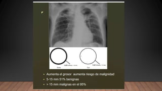 NEUMONIA.radiologia . Tipos ppt resumenn