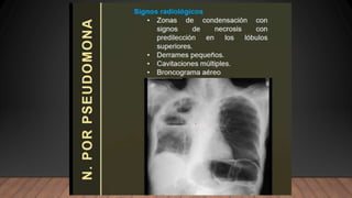NEUMONIA.radiologia . Tipos ppt resumenn