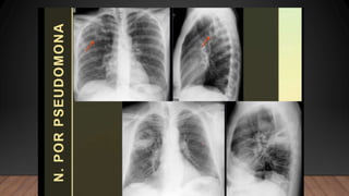 NEUMONIA.radiologia . Tipos ppt resumenn