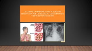 CUADRO DE CONDENSACION PULMONAR
PRODUCIDA POR UN EXUDADO INFLAMATORIO
Y PROCESO INFECCIOSO
 