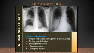 LOBAR O ALVEOLAR
 