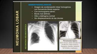 NEUMONIA.radiologia . Tipos ppt resumenn
