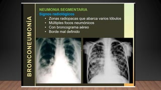 NEUMONIA.radiologia . Tipos ppt resumenn