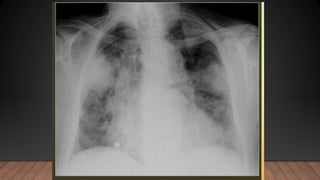 NEUMONIA.radiologia . Tipos ppt resumenn