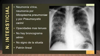NEUMONIA.radiologia . Tipos ppt resumenn