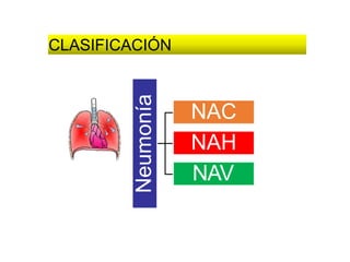 CLASIFICACIÓN
Neumonía
NAC
NAH
NAV
 