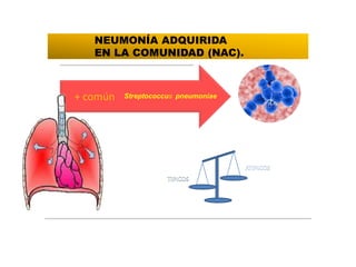 + común Streptococcus pneumoniae
NEUMONÍA ADQUIRIDA
EN LA COMUNIDAD (NAC).
 