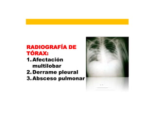 RADIOGRAFÍA DE
TÓRAX:
1.Afectación
multilobar
2.Derrame pleural
3.Absceso pulmonar
 