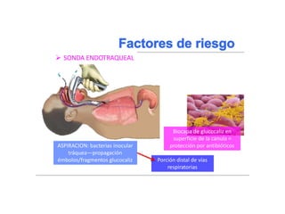 Braunwald, Eugene, and Tinsley Randolph Harrison. "NEUMONIA." Harrison: principios de medicina interna. Madrid:)
McGraw-Hill, 2002. 1619-1628. Impreso.
 SONDA ENDOTRAQUEAL
Lesión mucosa traqueal =
colonización
Biocapa de glucocaliz en
superficie de la canula =
ASPIRACION: bacterias inocular protección por antibióticos
tráquea—propagación
émbolos/fragmentos glucocaliz Porción distal de vías
respiratorias
 