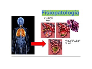 PULMON
SANO
PROLIFERACION
DE MO
 