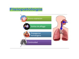 Bronco-aspiracion
Gotitas de pflügge
Propagacion
hematogena
Continuidad
 