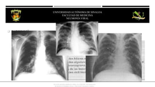  RADIOLOGÍA:
OCTAVIO RIVERO SERRANO (2009), 6TA EDICIÓN, NEUMOLOGÍA
KUMATE-GUTIERREZ (2013), 17MA INFECTOLOGÍA CLINICA
UNIVERSIDAD AUTÓNOMA DE SINALOA
FACULTAD DE MEDICINA
HEPATITIS VIRAL
UNIVERSIDAD AUTÓNOMA DE SINALOA
FACULTAD DE MEDICINA
NEUMONÍA VIRAL
 