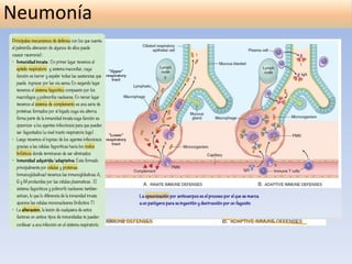 Neumonia(1).pdf