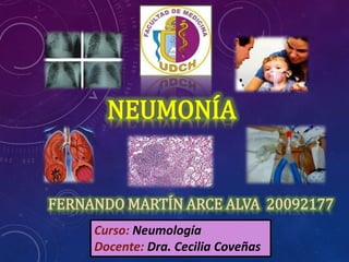 NEUMONÍA
FERNANDO MARTÍN ARCE ALVA 20092177
Curso: Neumología
Docente: Dra. Cecilia Coveñas
 