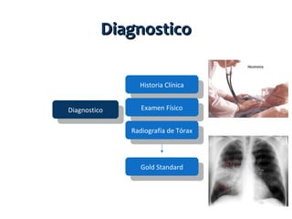 Diagnostico
Historia Clínica
Diagnostico

Examen Físico
Radiografía de Tórax

Gold Standard

 