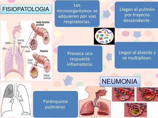 Neumonia adquirida en la comunidad