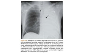Neumonia atelectasia