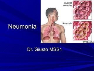 Neumonia


     Dr. Giusto MSS1
 