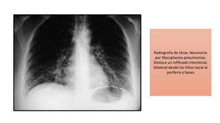 Radiografía de tórax. Neumonía
por Mycoplasma pneumoniae.
Destaca un infiltrado intersticial,
bilateral desde los hilios hacia la
periferia y bases
 