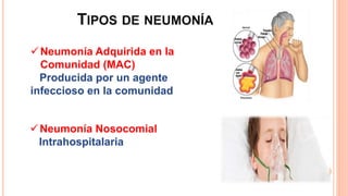 TIPOS DE NEUMONÍA
Neumonía Adquirida en la
Comunidad (MAC)
Producida por un agente
infeccioso en la comunidad
Neumonía Nosocomial
Intrahospitalaria
 
