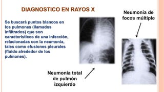 DIAGNOSTICO EN RAYOS X
Se buscará puntos blancos en
los pulmones (llamados
infiltrados) que son
característicos de una infección,
relacionadas con la neumonía,
tales como efusiones pleurales
(fluido alrededor de los
pulmones).
Neumonía total
de pulmón
izquierdo
Neumonía de
focos múltiple
 
