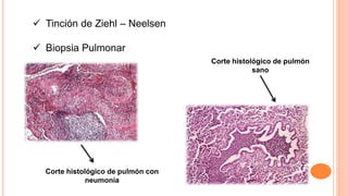  Tinción de Ziehl – Neelsen
 Biopsia Pulmonar
Corte histológico de pulmón
sano
Corte histológico de pulmón con
neumonía
 