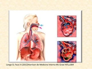 Longo D, Fauci A (2012)Harrison de Medicina Interna Mc Graw Hill p.804
 