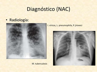 Diagnóstico (NAC)
• Radiología:
I. víricas, L. pneumophila, P. jiroveci
M. tuberculosis
 
