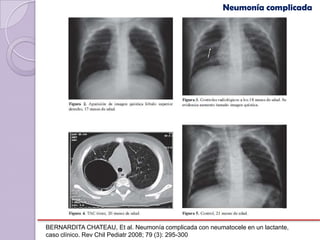 Neumonía complicada




BERNARDITA CHATEAU, Et al. Neumonía complicada con neumatocele en un lactante,
caso clínico. Rev Chil Pediatr 2008; 79 (3): 295-300
 
