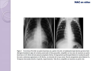 NAC en niños
 
