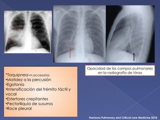 Harrisons Pulmonary and Critical care Medicine 2010
*Taquipnea-m.accesorios
•Matidez a la percusión
•Egofonía
•Intensificación del frémito táctil y
vocal
•Estertores crepitantes
•Pectoriliquia de susurros
•Roce pleural
Opacidad de los campos pulmonares
en la radiografía de tórax
 