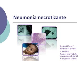 Neumonía necrotizante
Dra. Astrid Pezoa F.
Residente de pediatría
2° año 2014
Rotación Enfermedades
respiratorias del niño UC
P. Universidad Católica
 