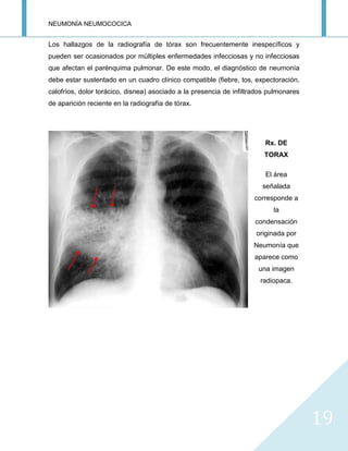 NEUMONÍA NEUMOCOCICA
19
Los hallazgos de la radiografía de tórax son frecuentemente inespecíficos y
pueden ser ocasionados por múltiples enfermedades infecciosas y no infecciosas
que afectan el parénquima pulmonar. De este modo, el diagnóstico de neumonía
debe estar sustentado en un cuadro clínico compatible (fiebre, tos, expectoración,
calofríos, dolor torácico, disnea) asociado a la presencia de infiltrados pulmonares
de aparición reciente en la radiografía de tórax.
Rx. DE
TORAX
El área
señalada
corresponde a
la
condensación
originada por
Neumonía que
aparece como
una imagen
radiopaca.
 