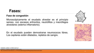 Fases:
Fase de congestión
Microscópicamente el exudado alveolar es al principio
seroso, con escasos eritrocitos, neutrófilos y macrófagos
alveolares (edema inflamatorio).
En el exudado pueden demostrarse neumococos libres.
Los capilares están dilatados, repletos de sangre.
ROMERO URIBE OLYMPIA NATALY
Capitulo 2: Aparato respiratorio (neumonía).
http://publicacionesmedicina.uc.cl/AnatomiaPatologica/02Respiratorio/2neumonia.html
11
 
