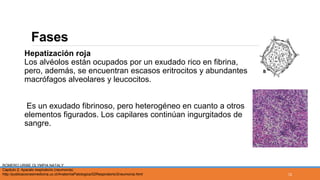 Fases
Hepatización roja
Los alvéolos están ocupados por un exudado rico en fibrina,
pero, además, se encuentran escasos eritrocitos y abundantes
macrófagos alveolares y leucocitos.
Es un exudado fibrinoso, pero heterogéneo en cuanto a otros
elementos figurados. Los capilares continúan ingurgitados de
sangre.
ROMERO URIBE OLYMPIA NATALY
Capitulo 2: Aparato respiratorio (neumonía).
http://publicacionesmedicina.uc.cl/AnatomiaPatologica/02Respiratorio/2neumonia.html 12
 