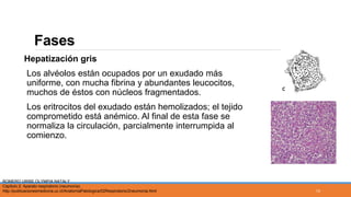 Fases
Hepatización gris
Los alvéolos están ocupados por un exudado más
uniforme, con mucha fibrina y abundantes leucocitos,
muchos de éstos con núcleos fragmentados.
Los eritrocitos del exudado están hemolizados; el tejido
comprometido está anémico. Al final de esta fase se
normaliza la circulación, parcialmente interrumpida al
comienzo.
ROMERO URIBE OLYMPIA NATALY
Capitulo 2: Aparato respiratorio (neumonía).
http://publicacionesmedicina.uc.cl/AnatomiaPatologica/02Respiratorio/2neumonia.html 13
 
