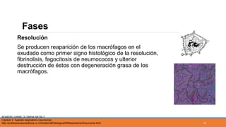 Fases
Resolución
Se producen reaparición de los macrófagos en el
exudado como primer signo histológico de la resolución,
fibrinolisis, fagocitosis de neumococos y ulterior
destrucción de éstos con degeneración grasa de los
macrófagos.
ROMERO URIBE OLYMPIA NATALY
Capitulo 2: Aparato respiratorio (neumonía).
http://publicacionesmedicina.uc.cl/AnatomiaPatologica/02Respiratorio/2neumonia.html 14
 