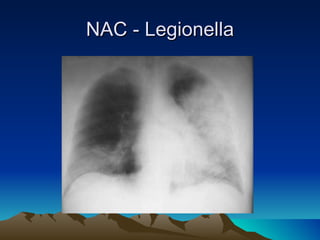 NAC - Legionella 