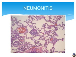 NEUMONITIS
 