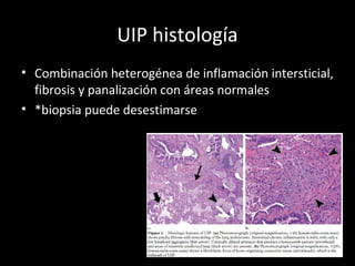 UIP histología
• Combinación heterogénea de inflamación intersticial,
fibrosis y panalización con áreas normales
• *biopsia puede desestimarse
 